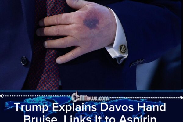 Trump Explains Davos Bruise, Downplays Health Concerns and Floats Idea of Another Term