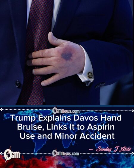 Trump Explains Davos Bruise, Downplays Health Concerns and Floats Idea of Another Term