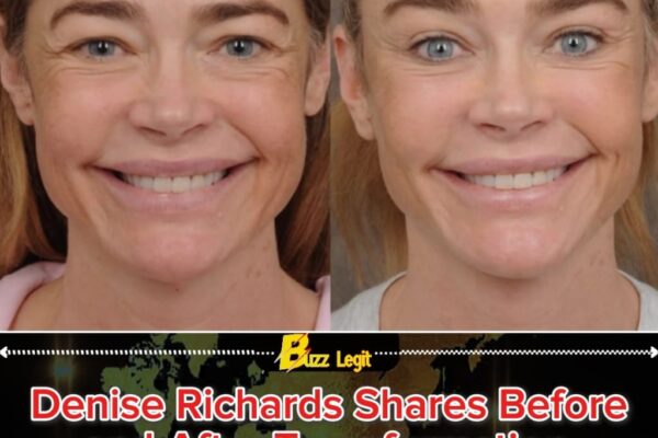 DENISE RICHARDS GIVES HER FACE — AND CONFIDENCE — A LIFT IN CANDID COSMETIC REVEAL