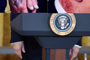 AMERICA IS NOT WELL — VIRAL HAND IMAGES OF PRESIDENT TRUMP SPARK ONLINE HEALTH SPECULATION AND POLITICAL DEBATE