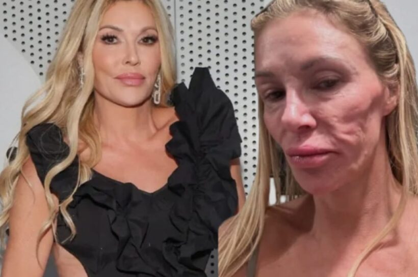 Brandi Glanville’s “Ringworm Scare” Confession Sparks Outrage, Medical Debate, and Internet Chaos