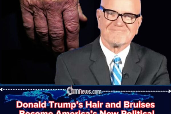 Donald Trump Faces New Questions Over Bruising and Appearance Changes